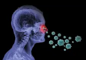 Nasal disease Sinusitis