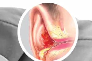 कर्ण रोग लक्षण   कारण  बचाव