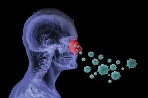 Nasal disease Sinusitis